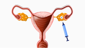 난자 채취